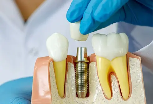 Dental Implants Meerut