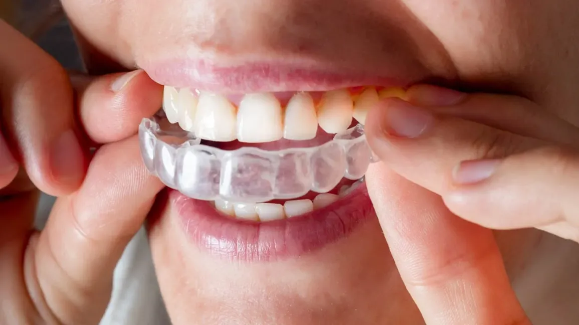 Invisalign Vadodara