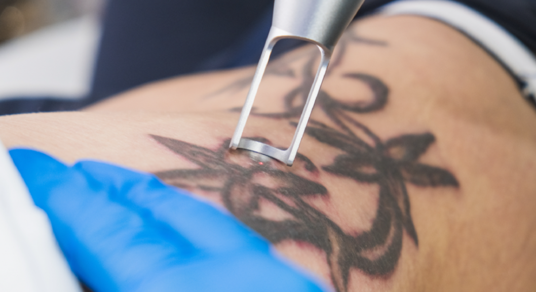 Tattoo Removal