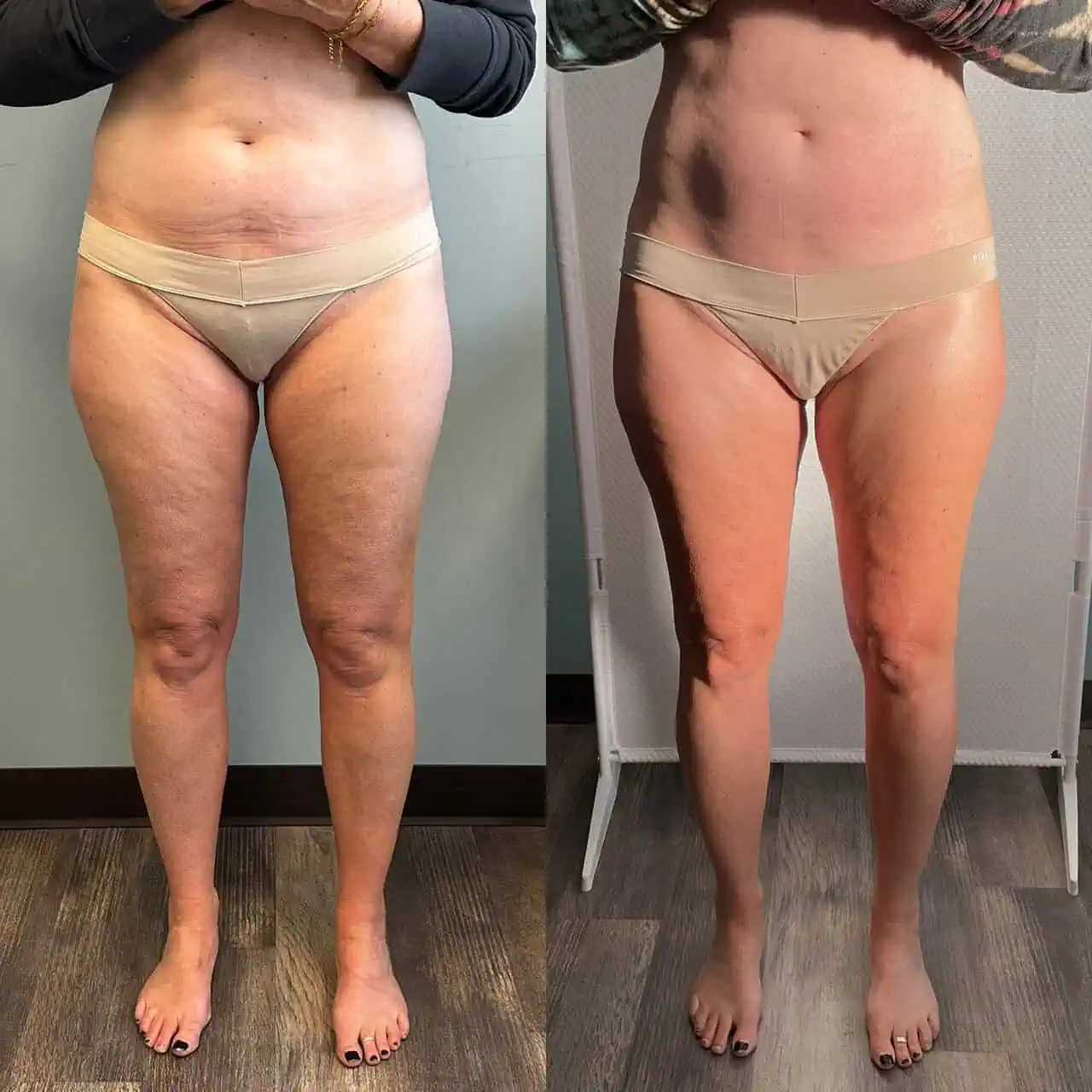 Body Cellulite Care