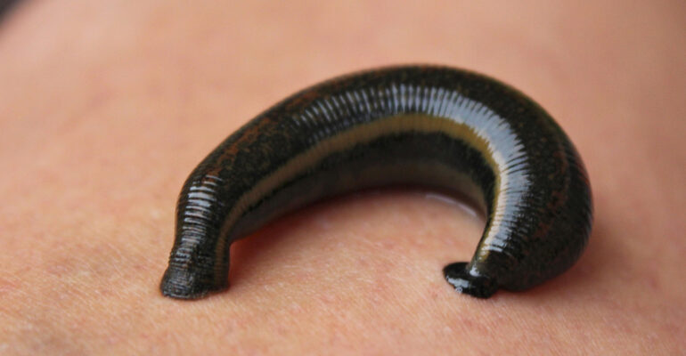 Leech Therapy Thane - Jalaukavacharan Raktamokshana