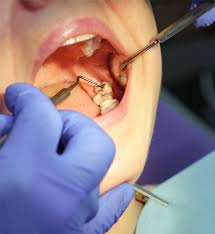 Wisdom Tooth